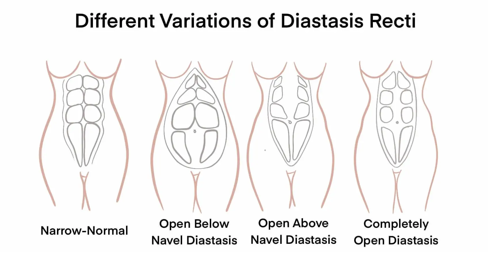 Diastasis Recti Variations - Pelvic Floor Strong can help